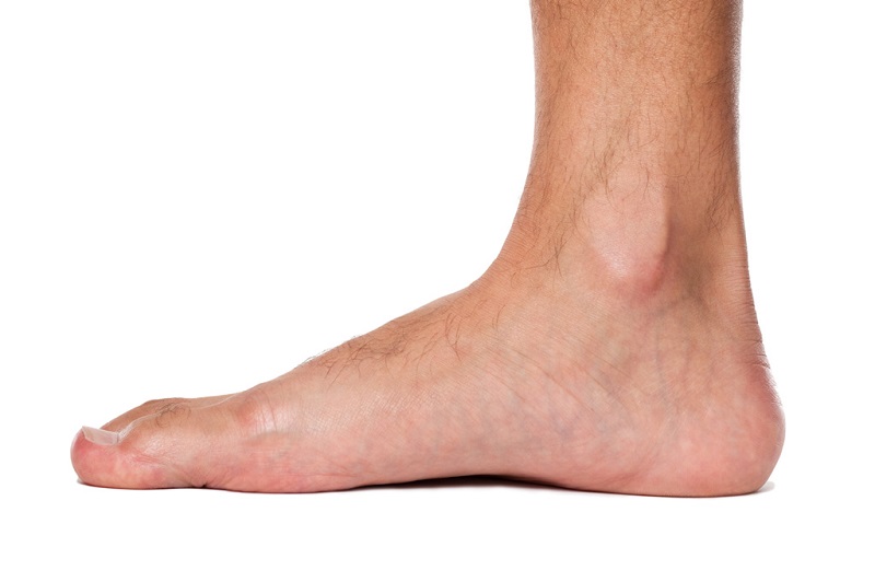 flat feet treatment sydney