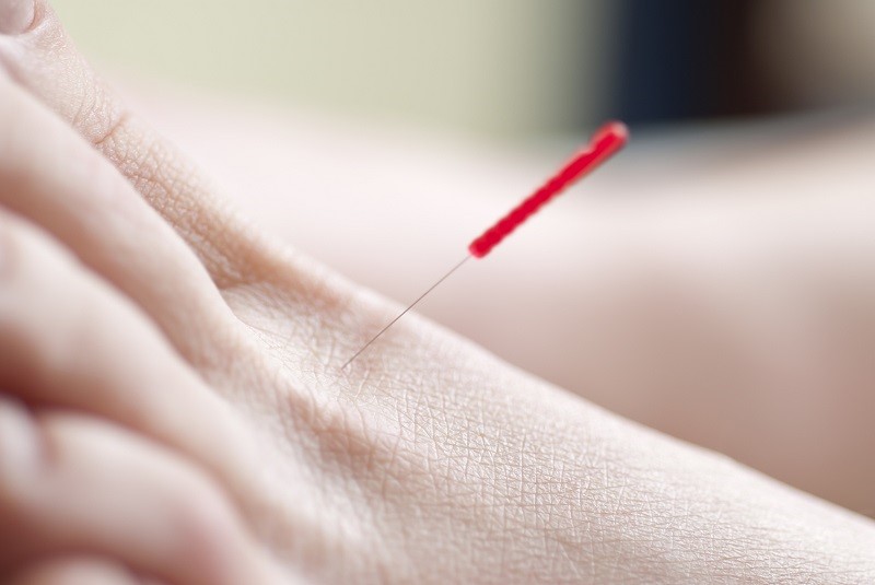 dry needling treatment sydney